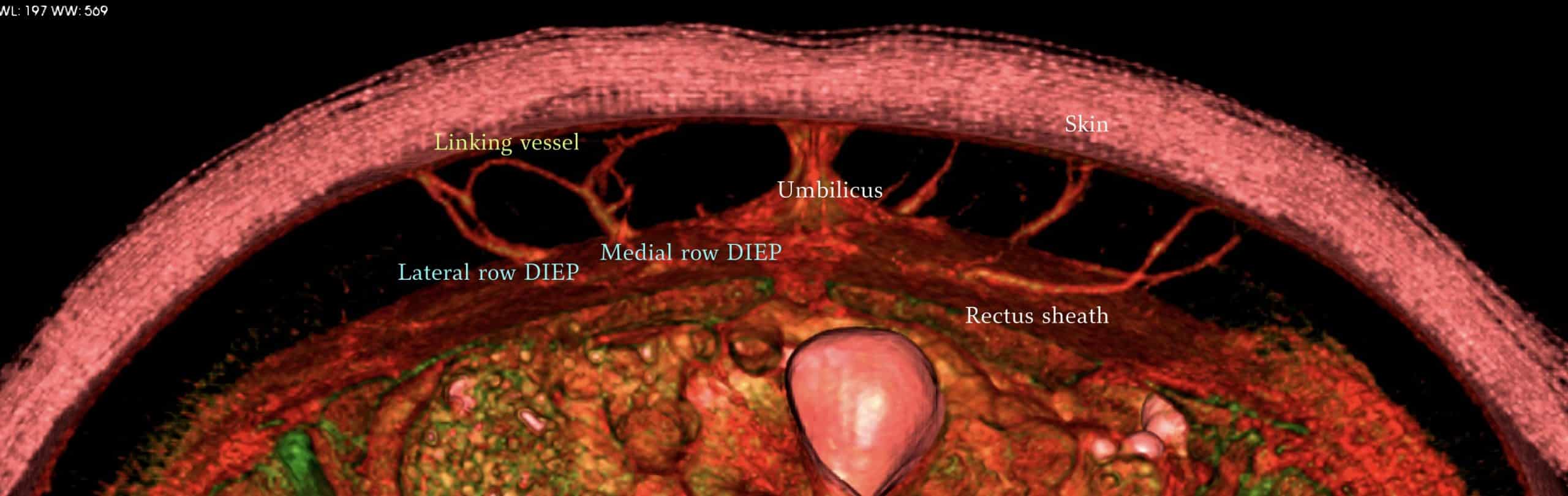 Holm's Zones of Perfusion