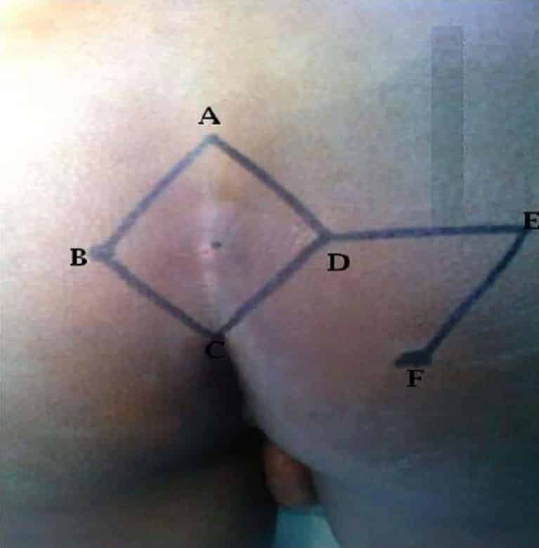 Rhomboid Flap for Pilonidal Disease