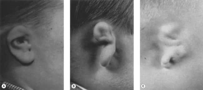 Meurman Classification of the Ear for Hemifacial Microsomia