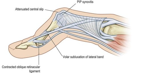 Anatomy and Mechanics of a Boutonnière Deformity (Triangular ligament, central slip, lateral bands)