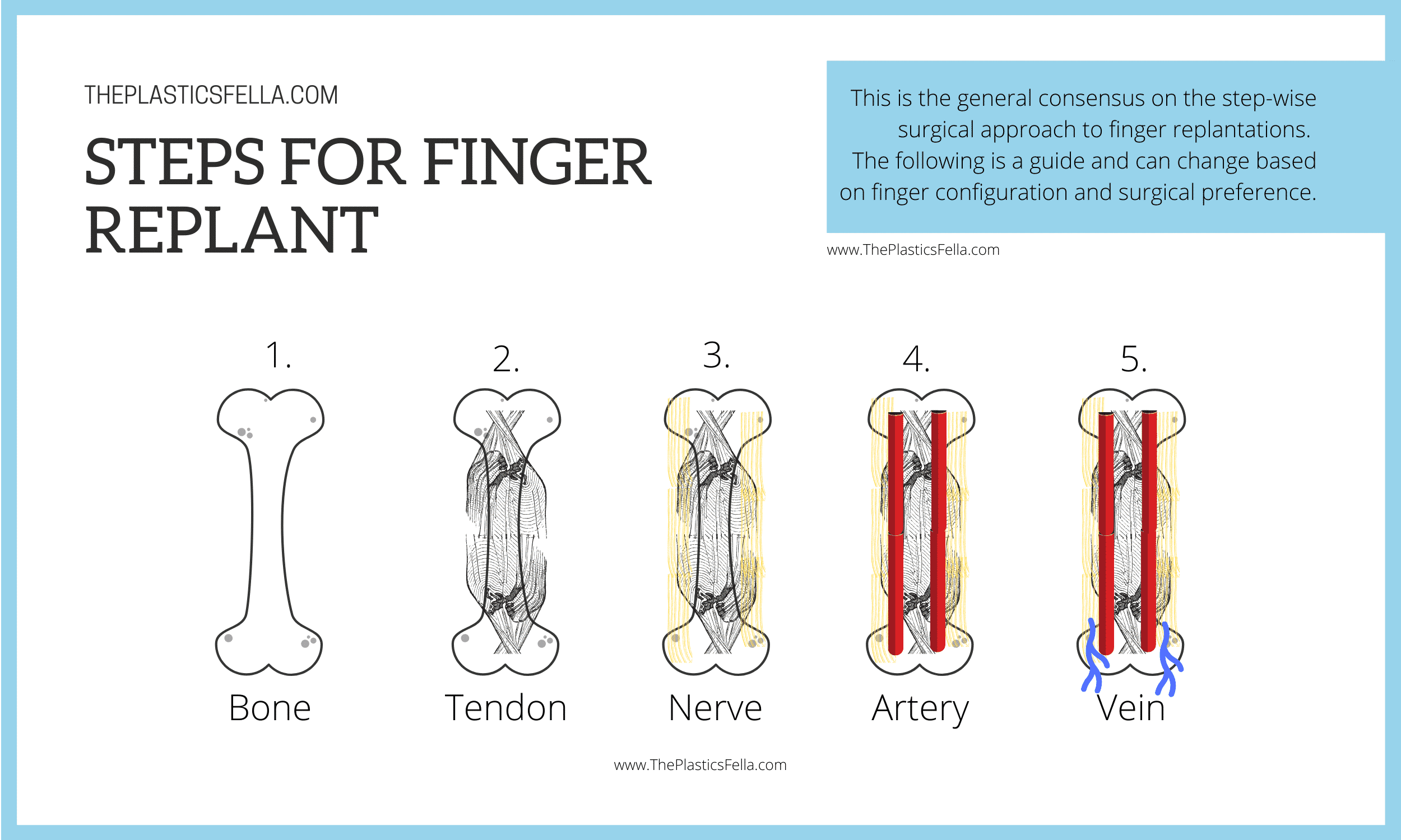 How to Replant a Finger Amputation