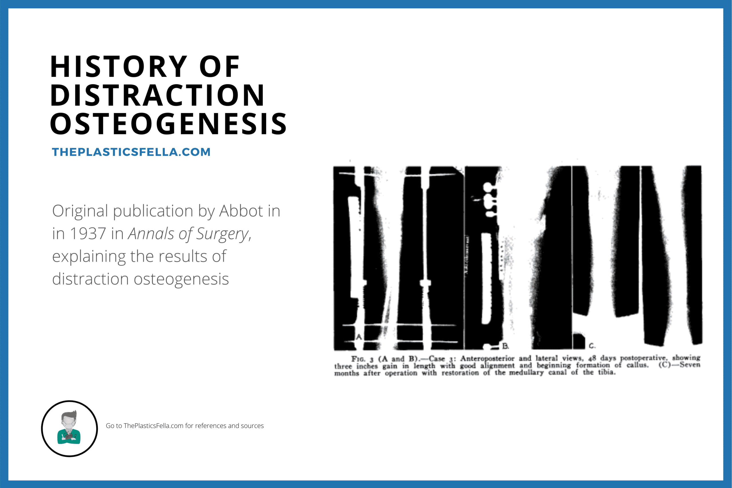 History of Distraction Osteogenesis, Ilizarov, Craniofacial