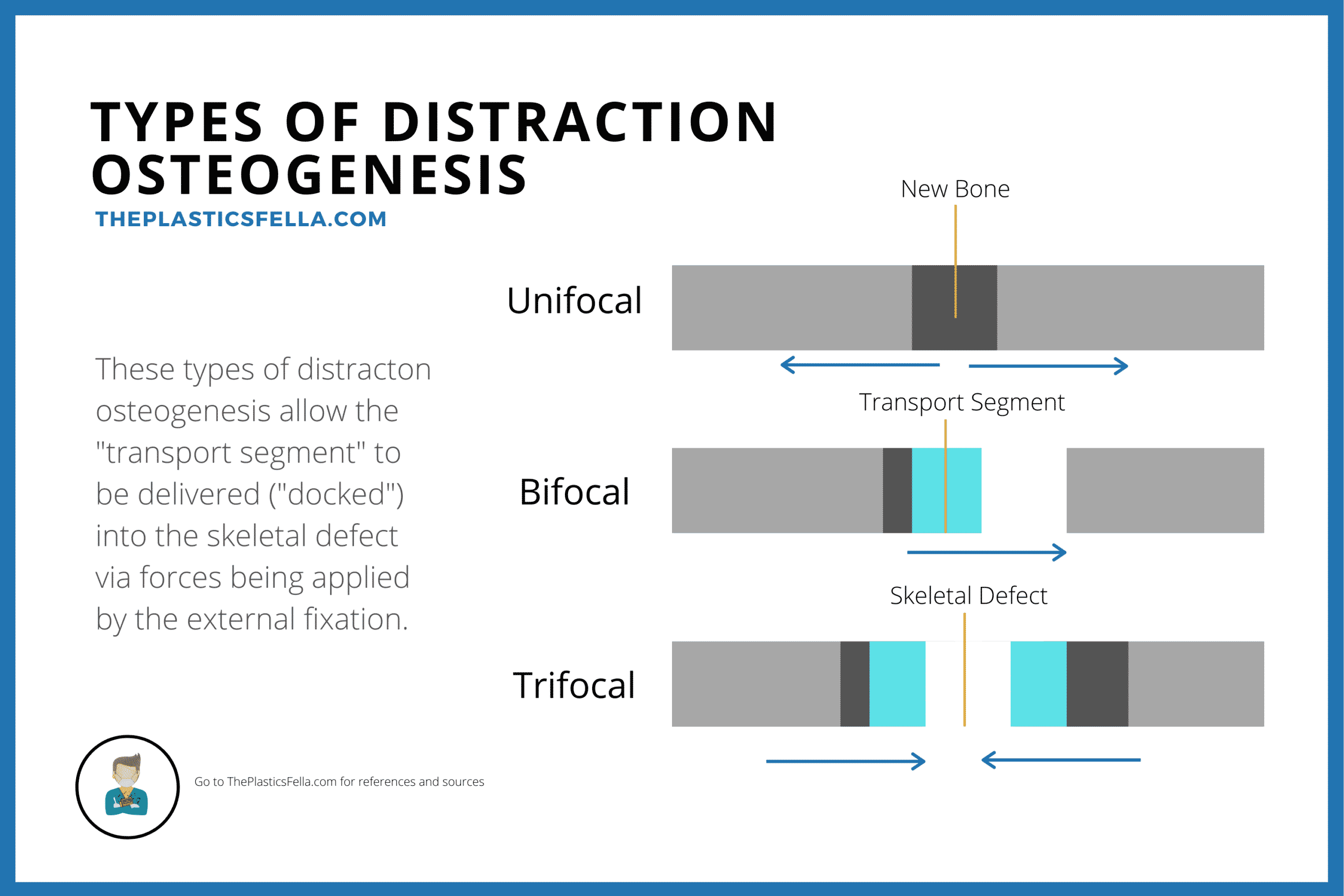 Types of Distraction Osteogenesis, Unifocal, Bifocal and Trifocal allow the transport segment to dock into the skeletal defect.