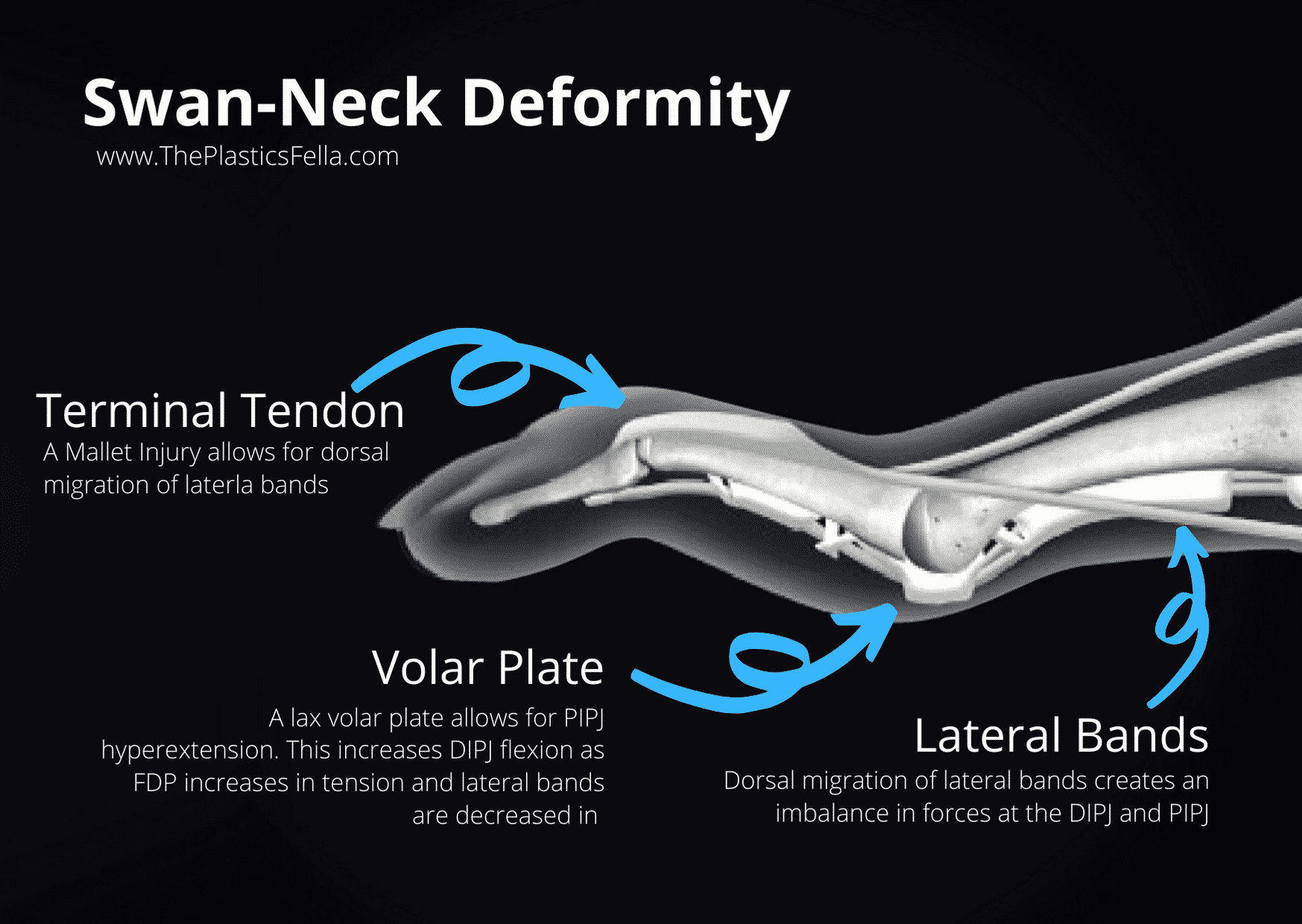 Anatomy of a Swan-Neck Deformity (vs Boutonnières deformity)