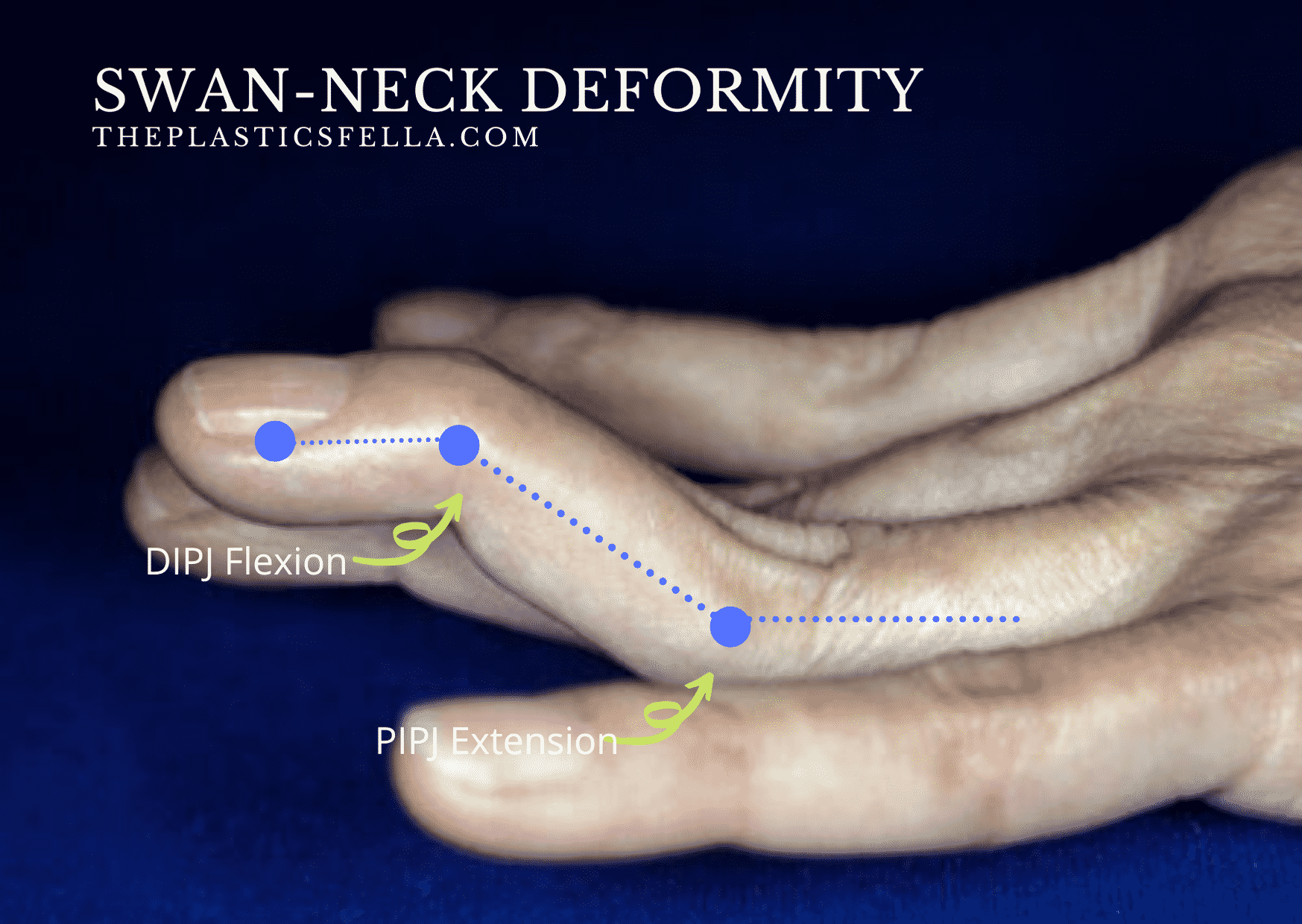 Signs of a Swan-Neck Deformity: DIPJ flexion, PIPJ hyperextension in a patient with Rheumatoid Hands