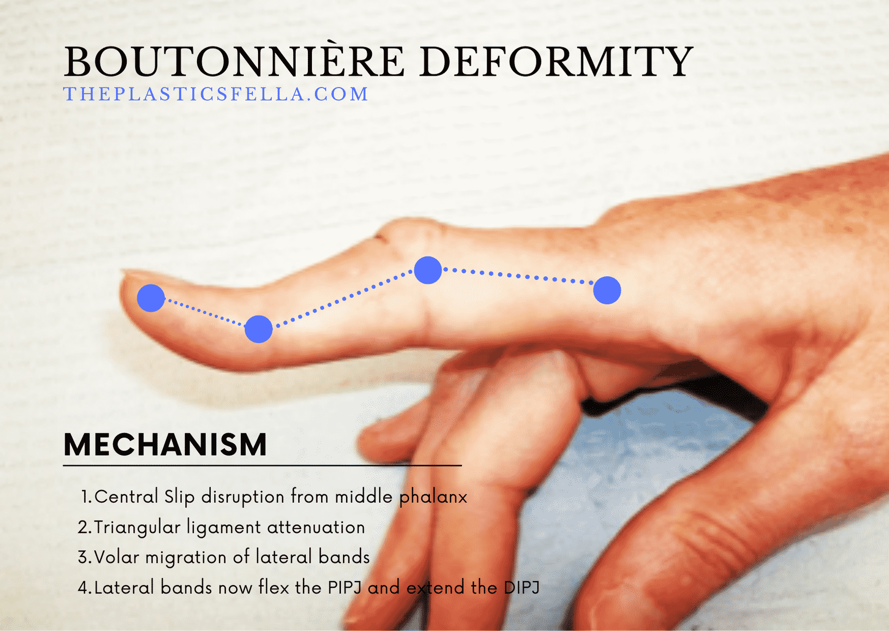 Signs and Biomechanics of a Boutonniere Deformity