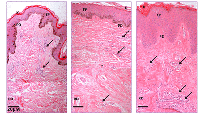 Histological and Morphological differences of Keloid, Hypertrophic and Normal scars