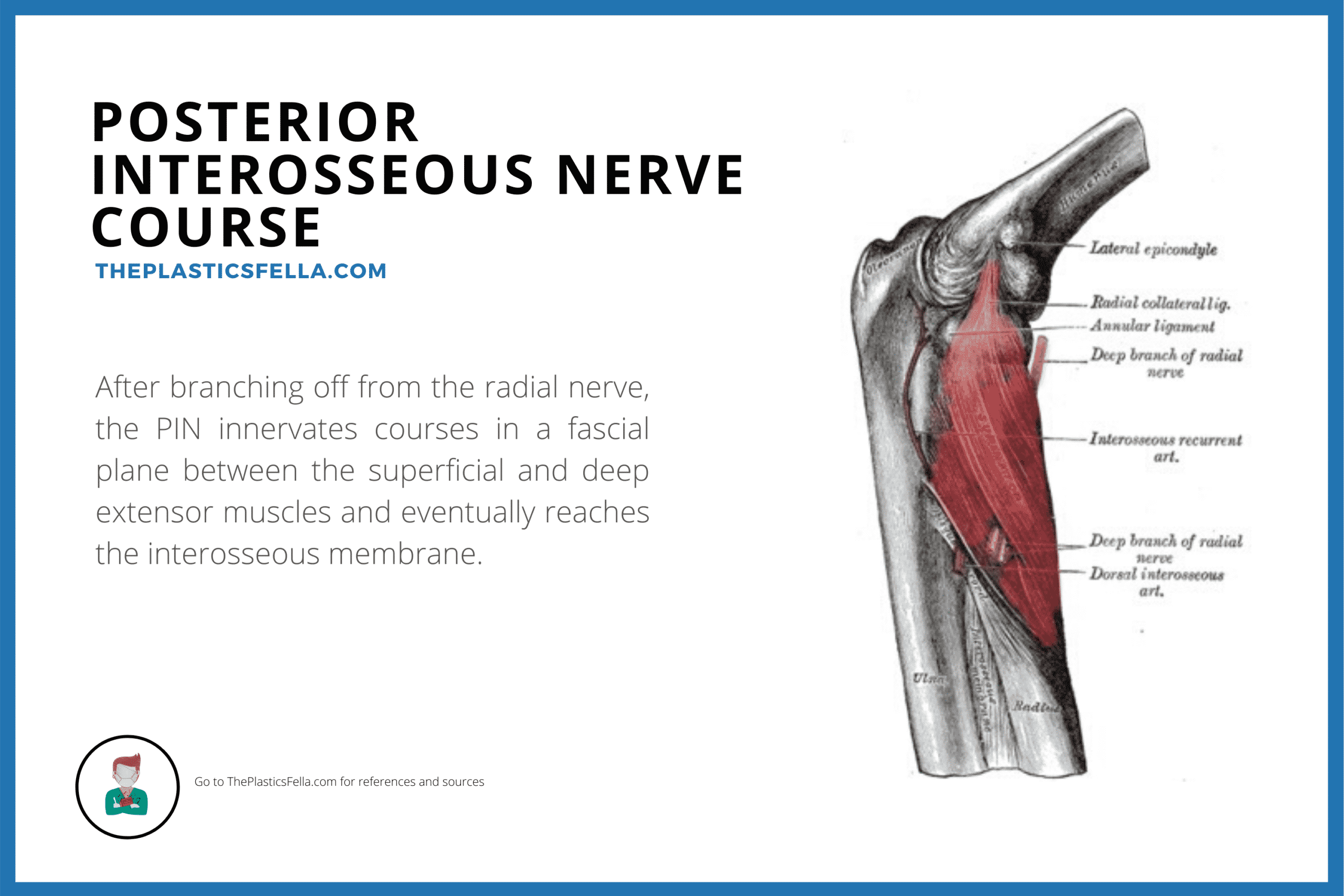 Anatomy of the Posterior Interosseous Nerve and it's course in the arm in causing Posterior Interosseous Nerve syndrome and palsy