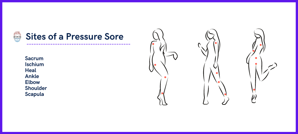 Sites and Location of a Pressure Sore