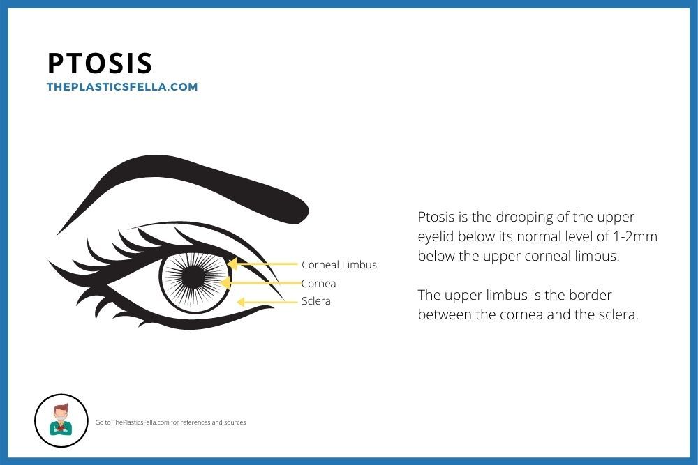 Ptosis is the drooping of the upper eyelid below its normal level of 1-2mm below the upper corneal limbus. This is a labelled drawing.