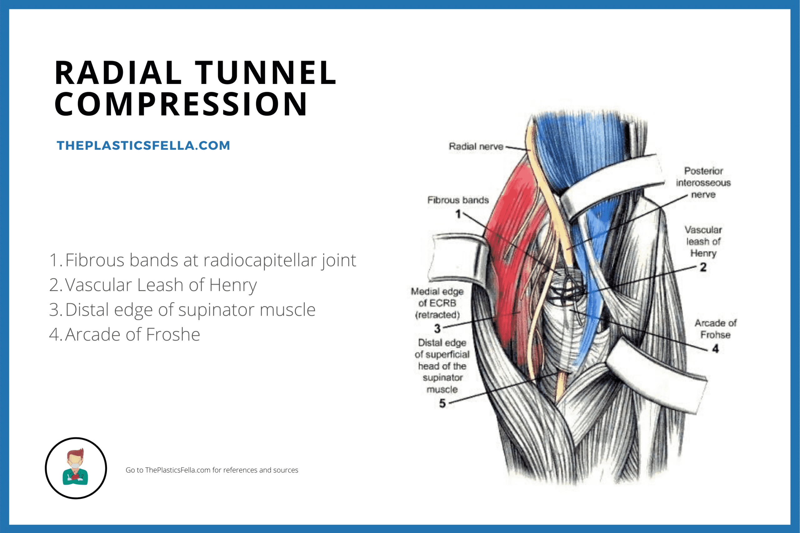 Sites of Radial Tunnel Compression and Entrapment in radial tunnel syndrome and Posterior Interosseous nerve palsy/syndrome.