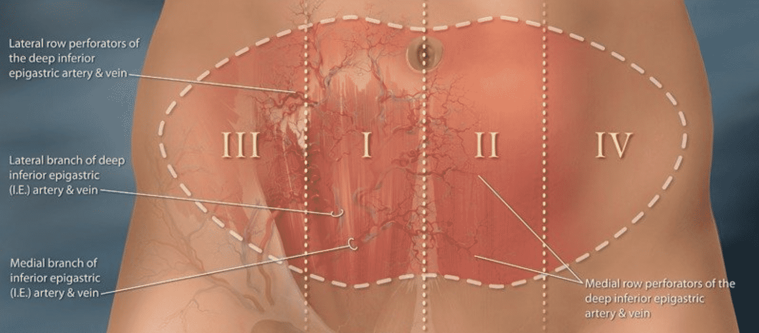 Hartrampf's Zones of Perfusion