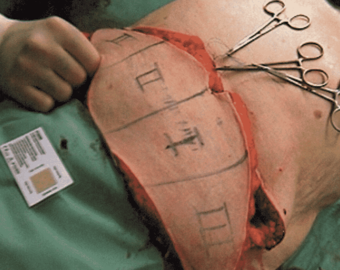 Hartrampf's Zones of Perfusion