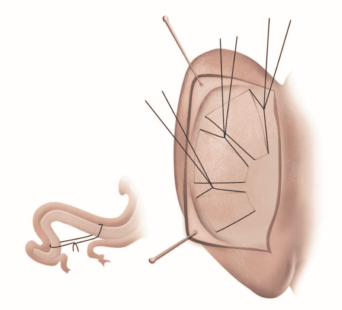 Mustardé Matress Suture to recreate the Anti-Helical Fold