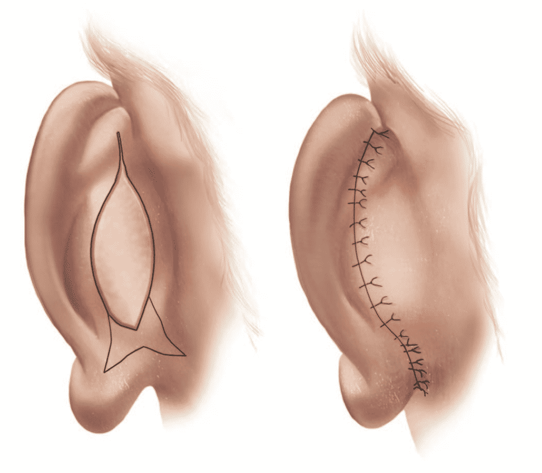Modified Fish-Tail Technique