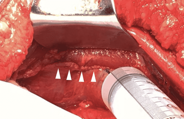 Ultrasound-Guided Anatomical Layout for TAP Blocks