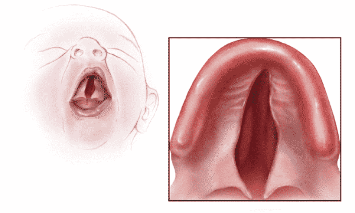 U-Shaped Cleft Palate linked with Pierre Robin Sequence