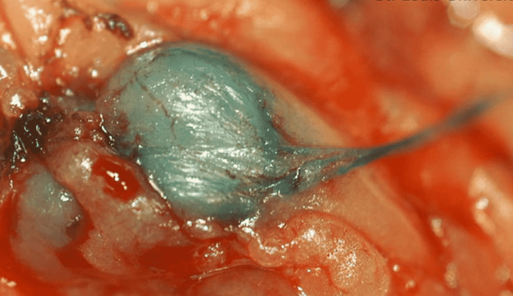 Blue Node in Sentinel Lymph Node Biopsy in Melanoma