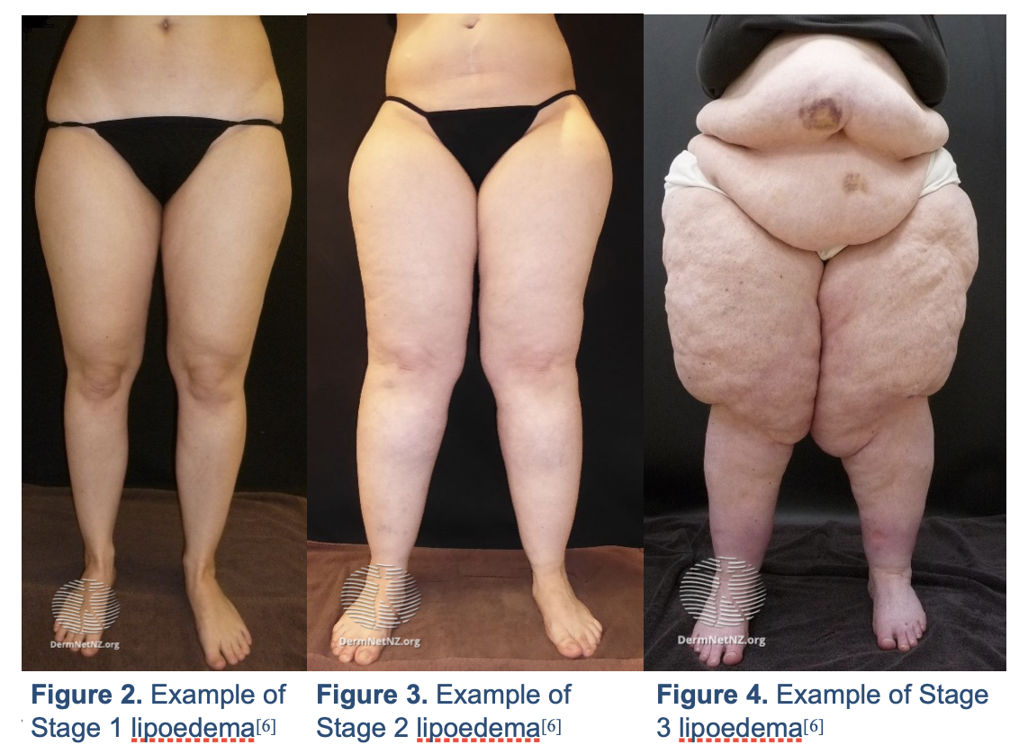 Sintomas lipedema Sintomas lipedema