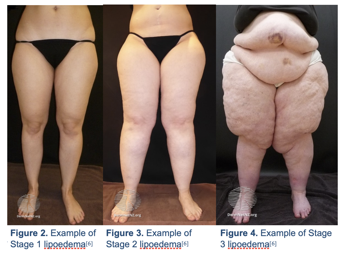 Stages and features of lipedema. (a) to (f): Front and back