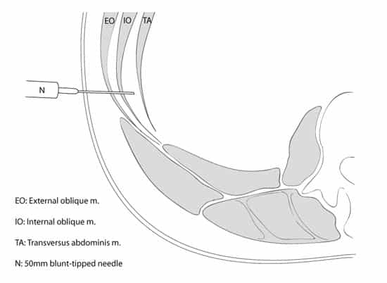 Anatomy of a TAP Block