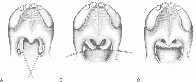 Sphincter Pharyngoplasty