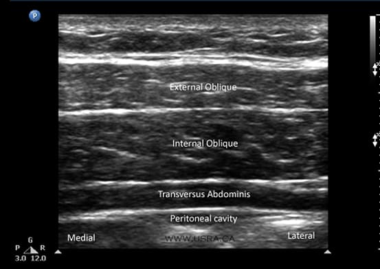 Direct visualization of TAP Block: Anaesthetic injected into the intramuscular plane adjacent transversus abdominis (arrows)