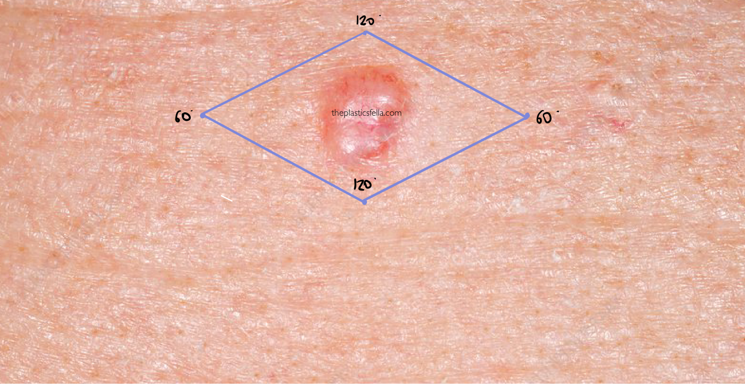 Design a Rhomboid Flap