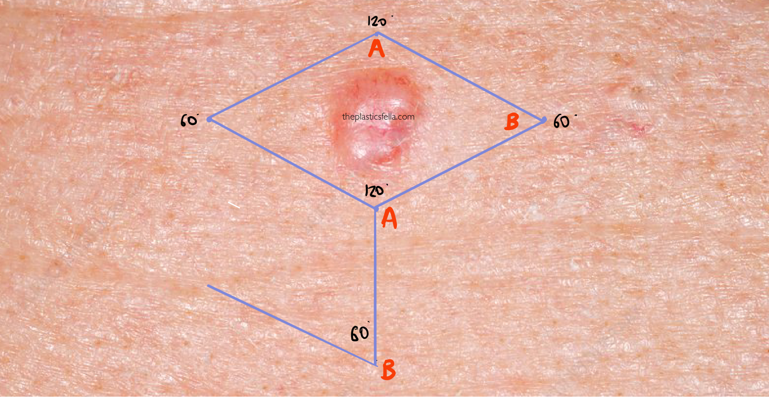 Rhomboid flap drawing on face