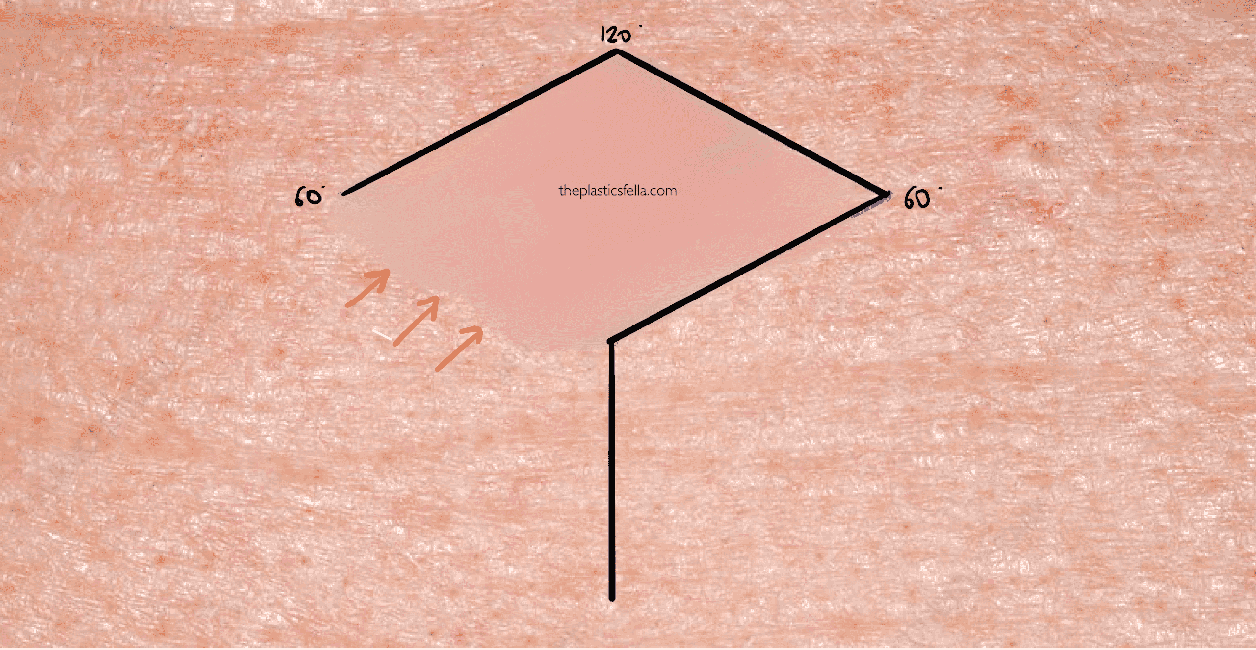 Drawing a rhomboid flap