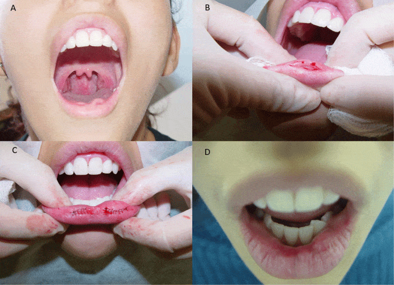 Surgical correction of the labial pits through navicular incision along the lower lip semi mucosa, followed by excision and layered closure​6​.