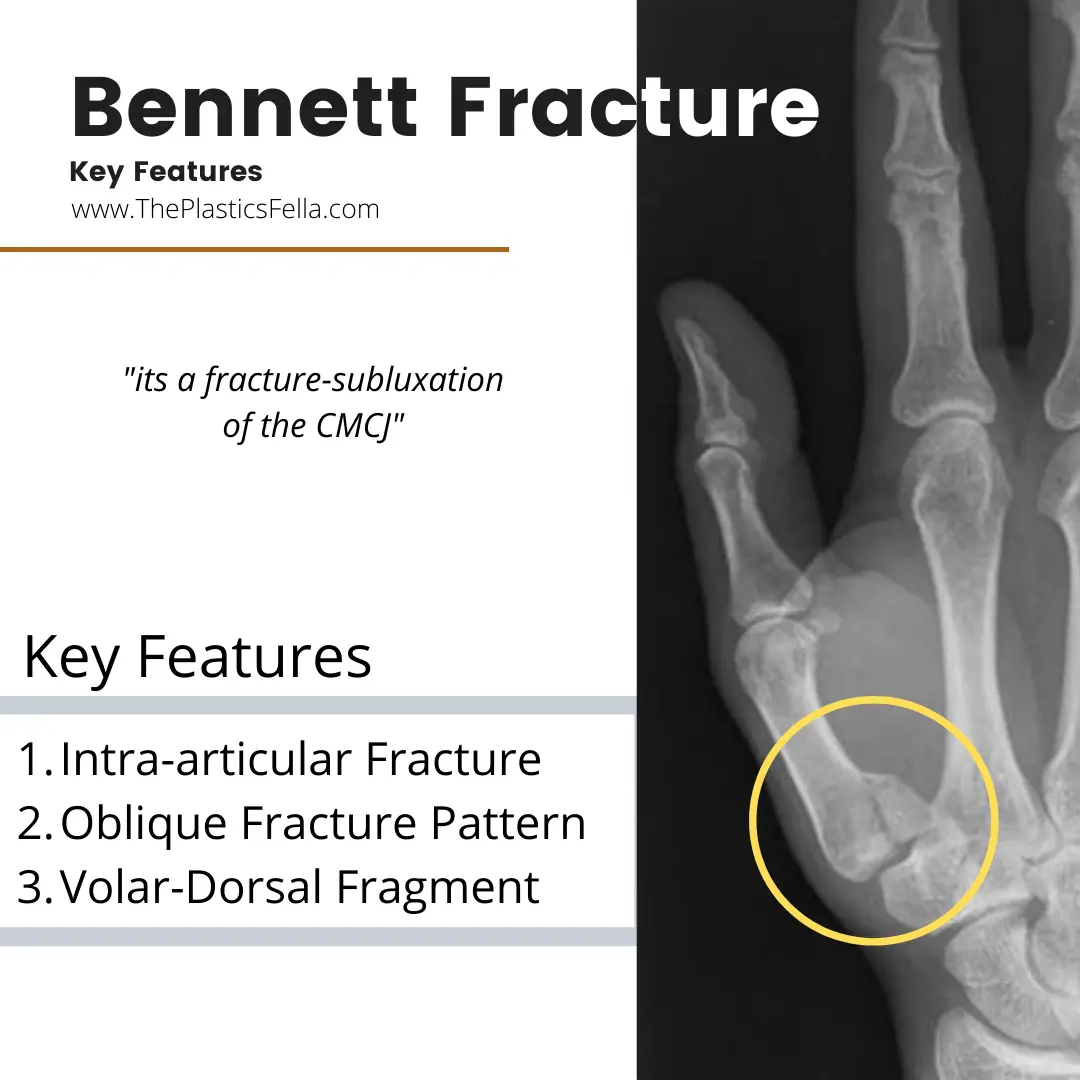 Bennett Fracture