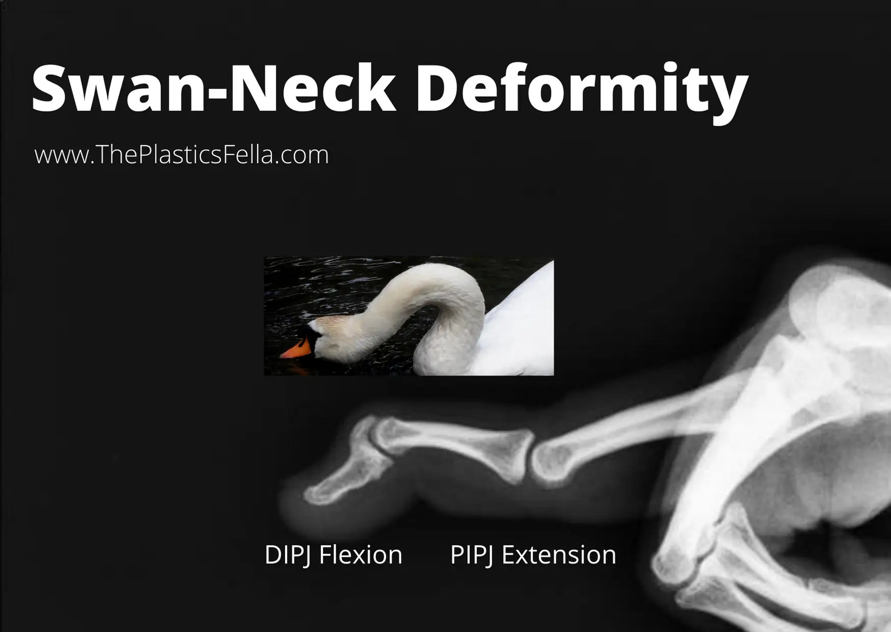 Radiological Findings of a Swan-Neck Deformity, X-Ray