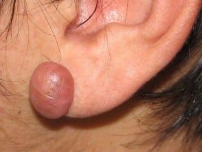 Keloid Scar