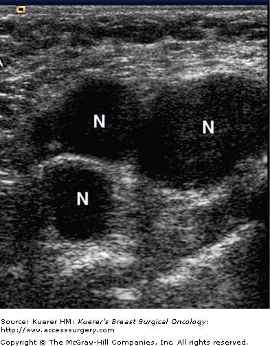 Ultrasound Evaluation of the Lymphatic Spread in Melanoma