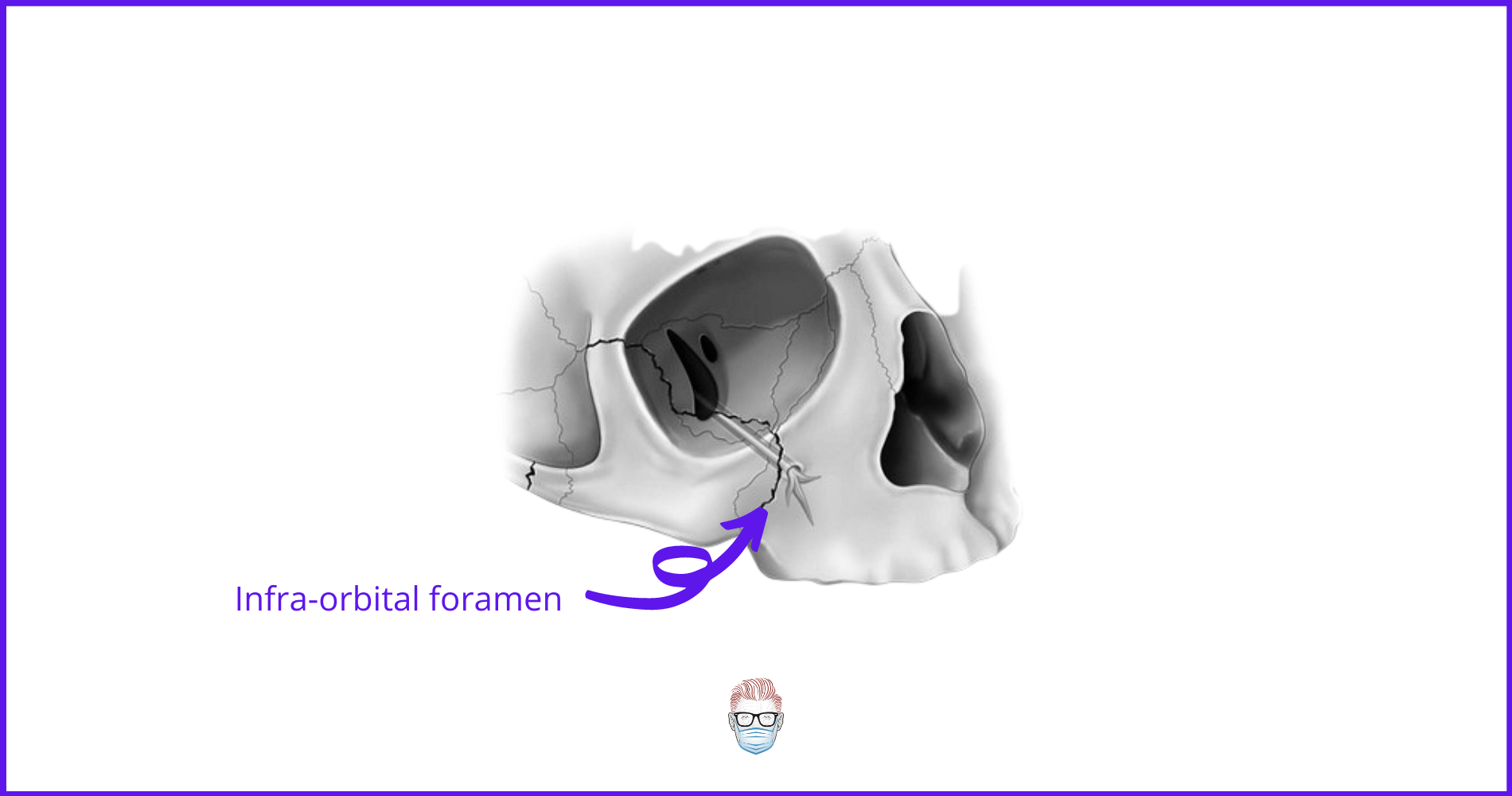 infraorbital nerve, foramen, zygoma, facial fractures, ZMC fractures