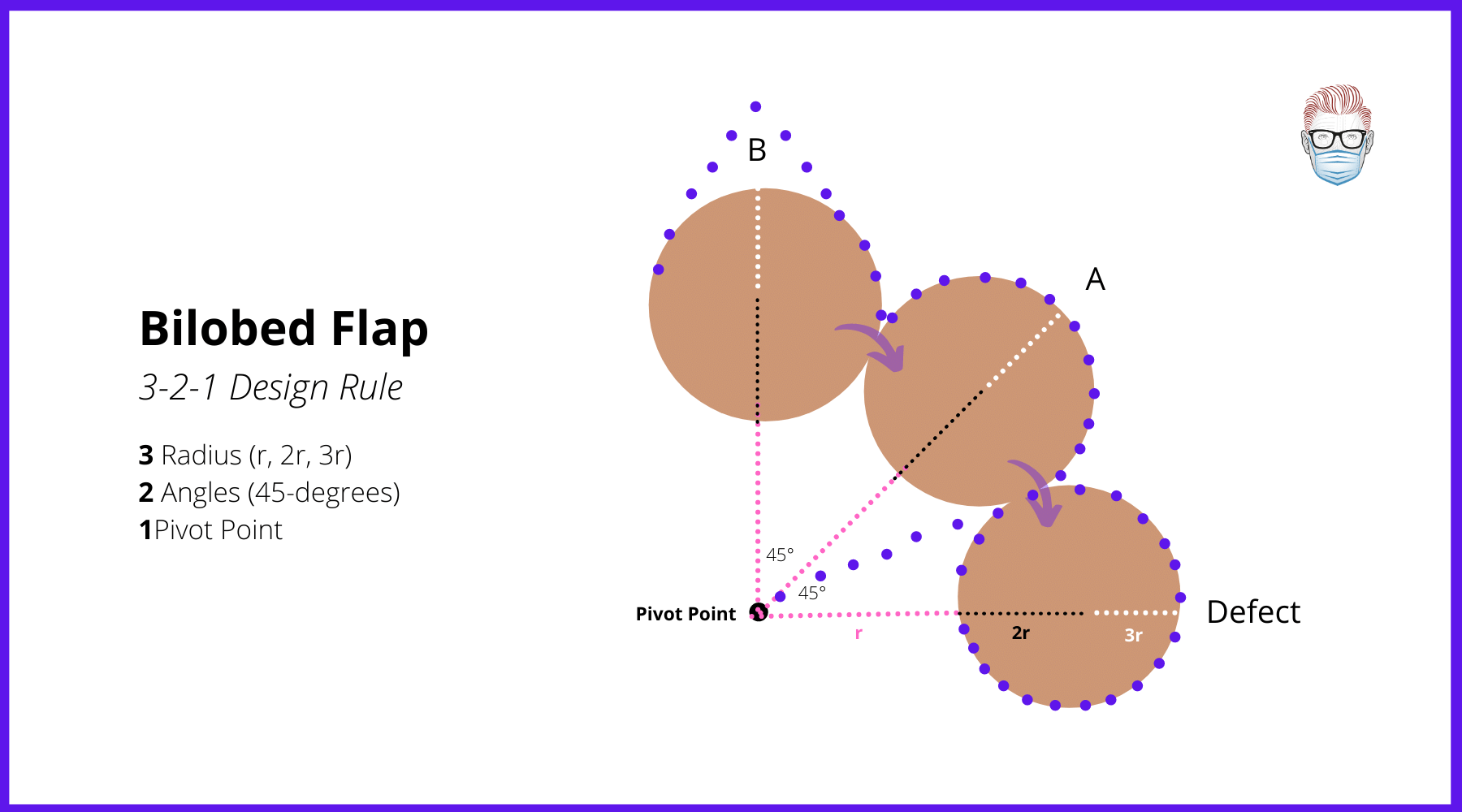 Design and Geometry of a Bilobed Flap around a Pivot Point (Zitelli Modificaton from Esser's flap) for nasal tip defects, pictures, medial canthus