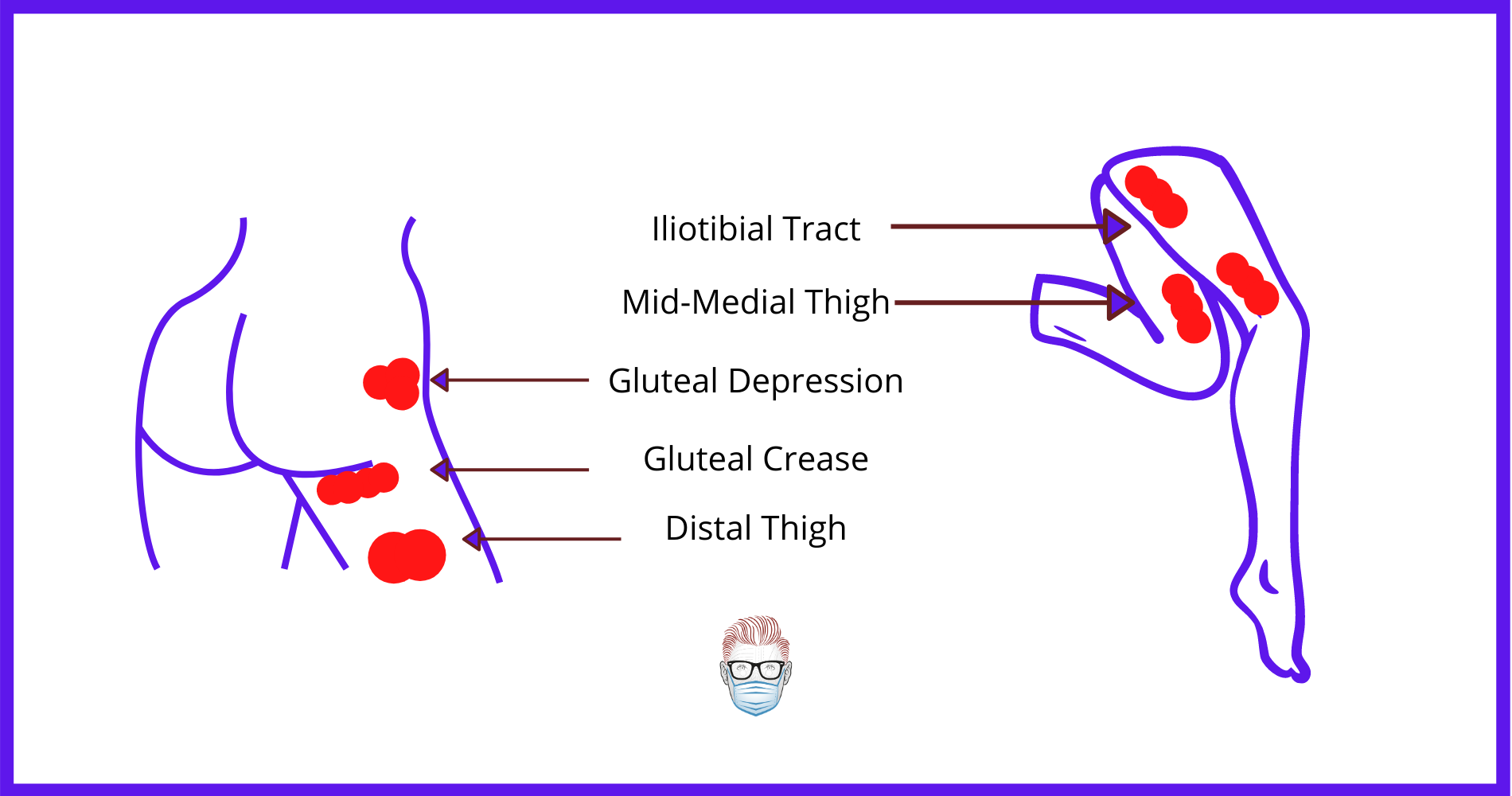 zones of adherence in liposuction to avoid complications and contour deformities 