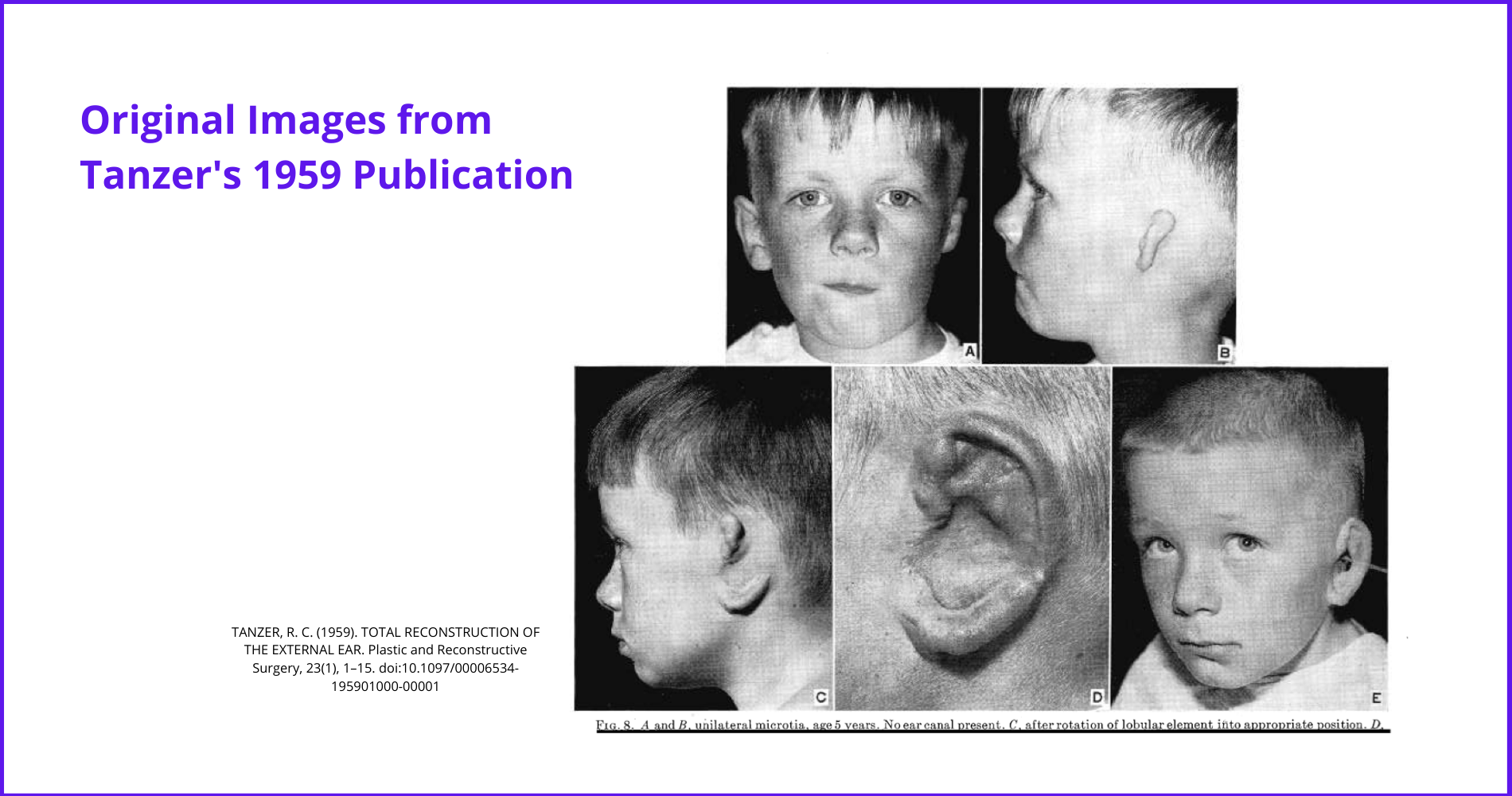 microtia, Tanzer, ear reconstruction, auricl, Brent, Nagata, surgery
