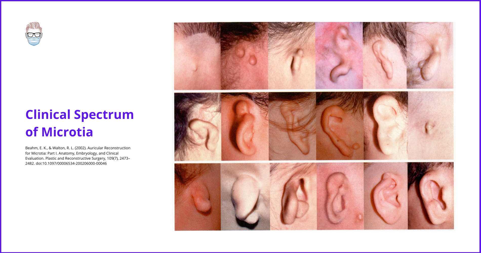 microtia, Tanzer, ear reconstruction, auricl, Brent, Nagata, surgery