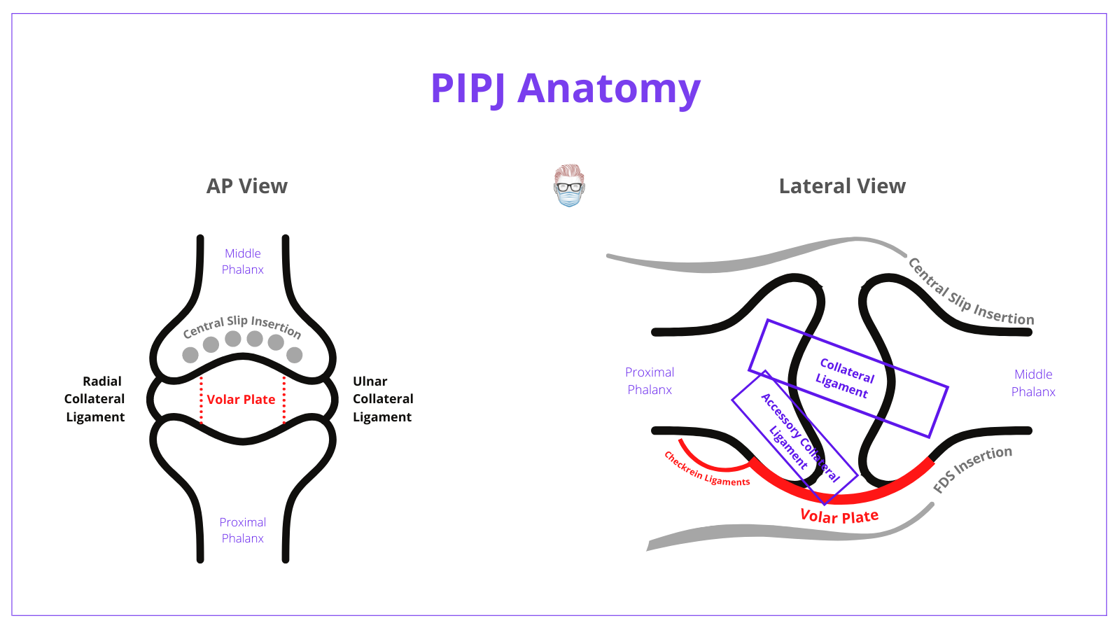 Anatomy, Proximal Interphalangeal Joint, PIPJ, Dislocation