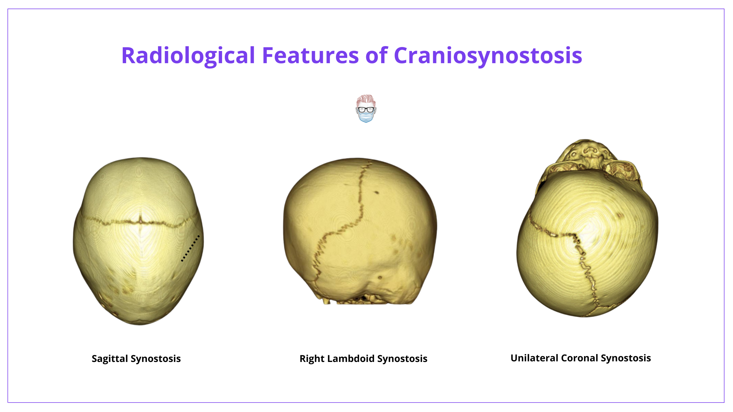 Radiological Features of Craniosynostosis, Scaphocephaly, Plagiocephaly, Trigonocephaly, Bracycephaly