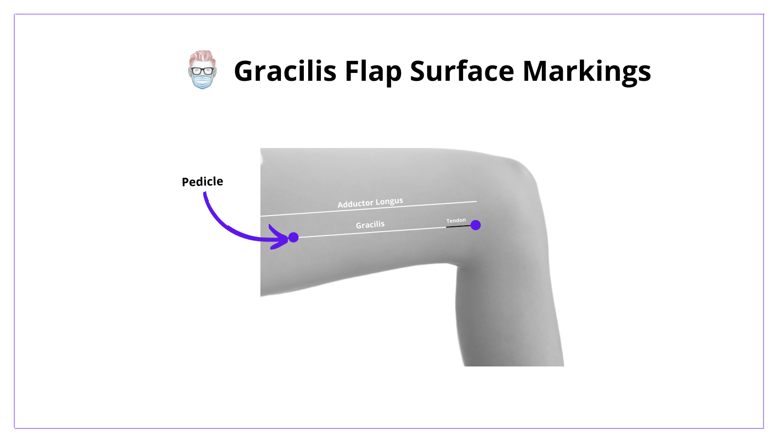 gracilis muscle, gracilis flap, surface markings, skin markings, design, how to, gracilis, muscle, flap, anatomy