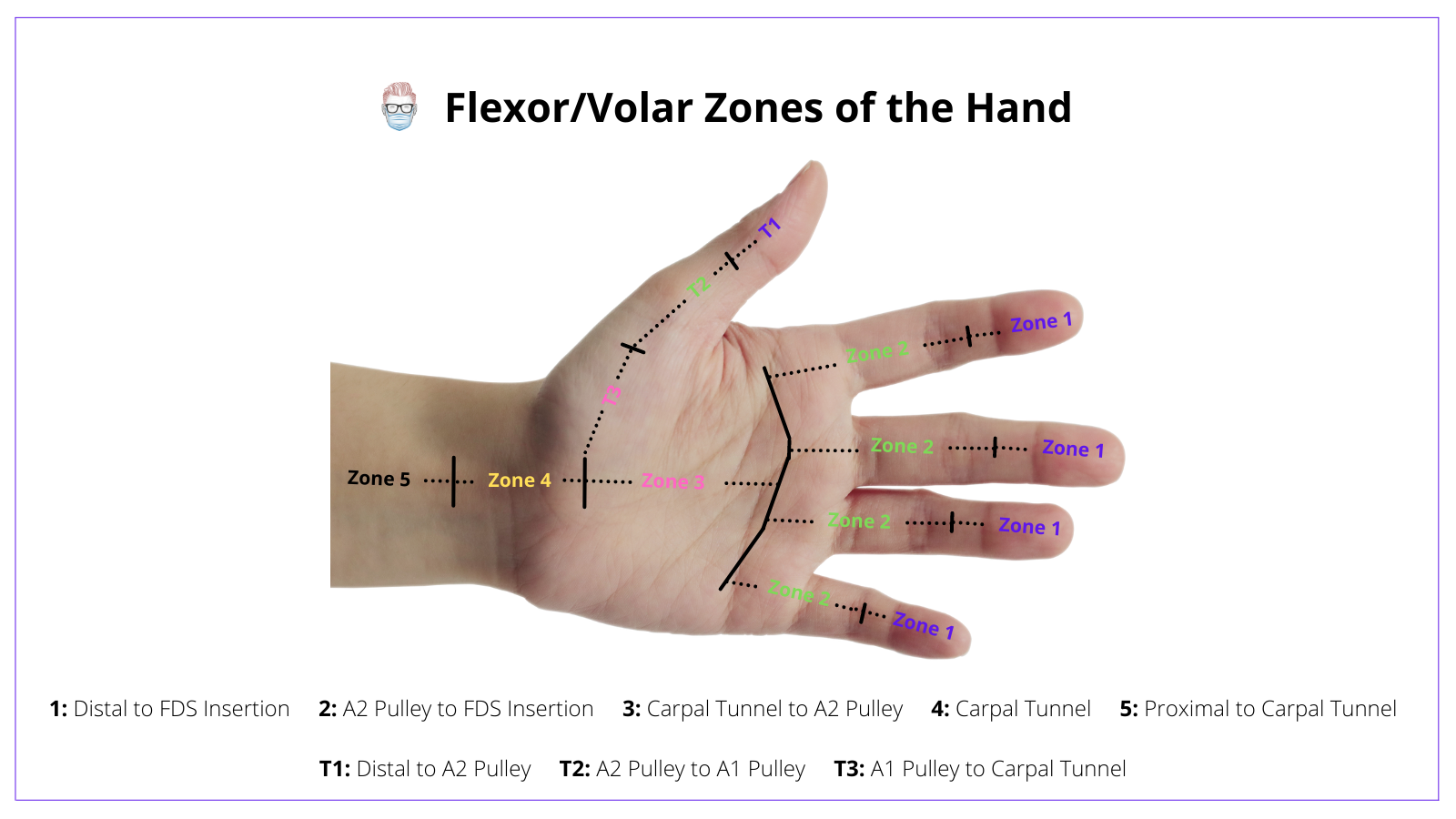 Zones of Flexor Tendon Injuries and Repairs, Flexor Tendon Zones, Zones, Flexor Tendons