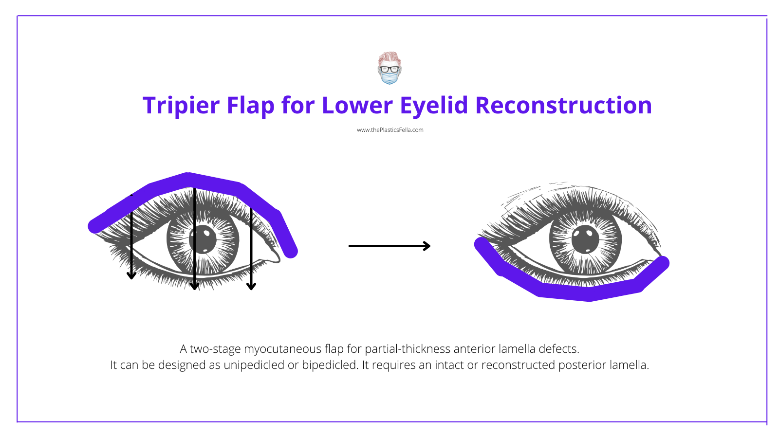 Tripier Flap for Lower Eyelid Reconstruction, Tripier Flap, Lower Eyelid Reconstruction