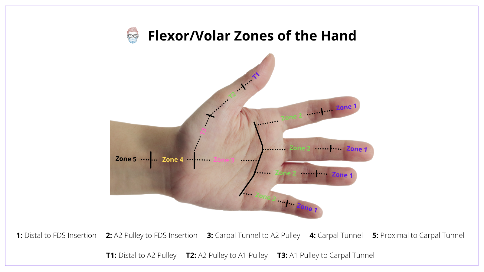 Flexor Zones of the Hand, Volar Zones of the Hand, Zone, 1, 2, 3, 4, 5, Thumb
