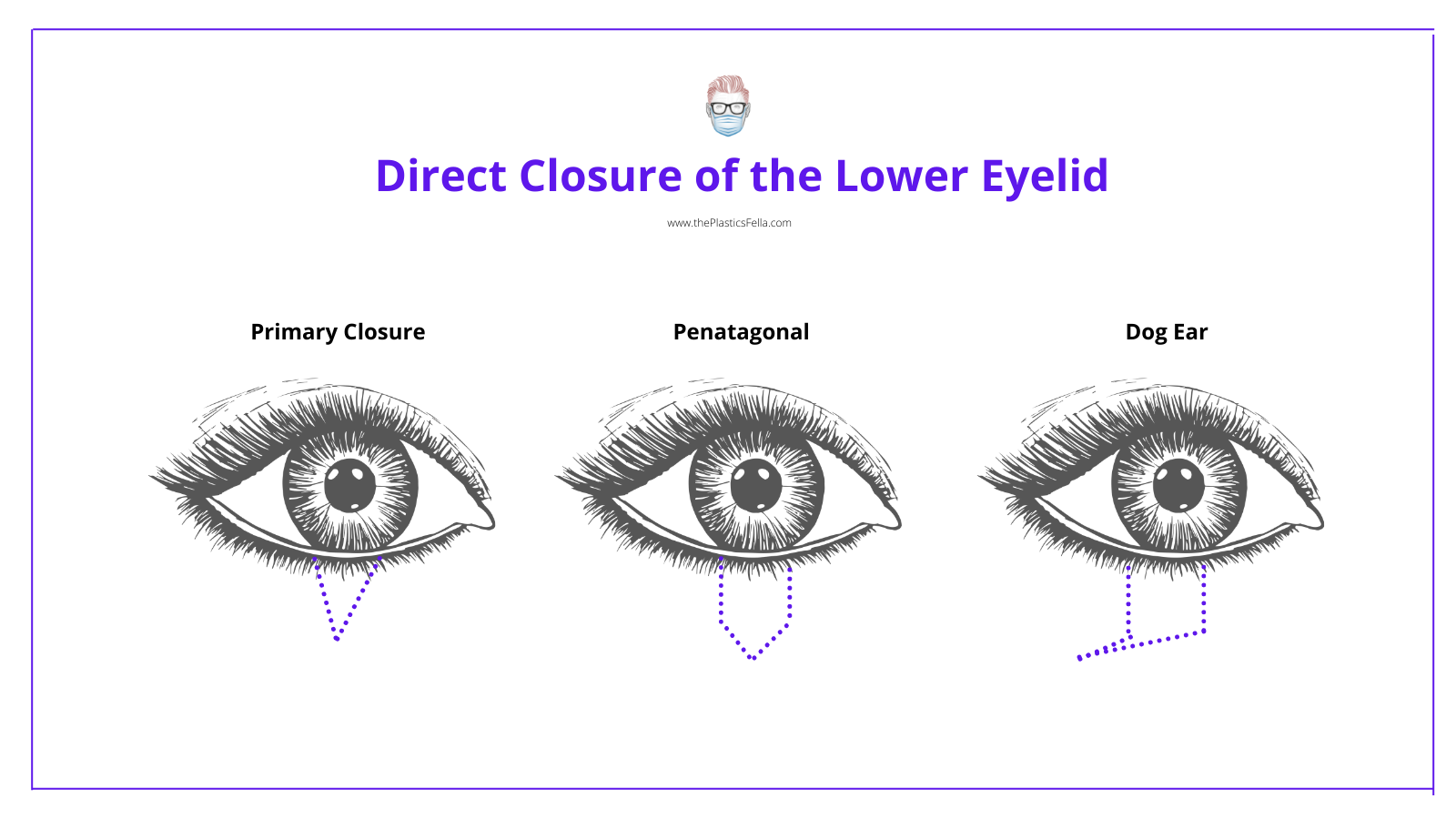 Primary Closure, Pentagonal Incision, Dog Ear Incision 