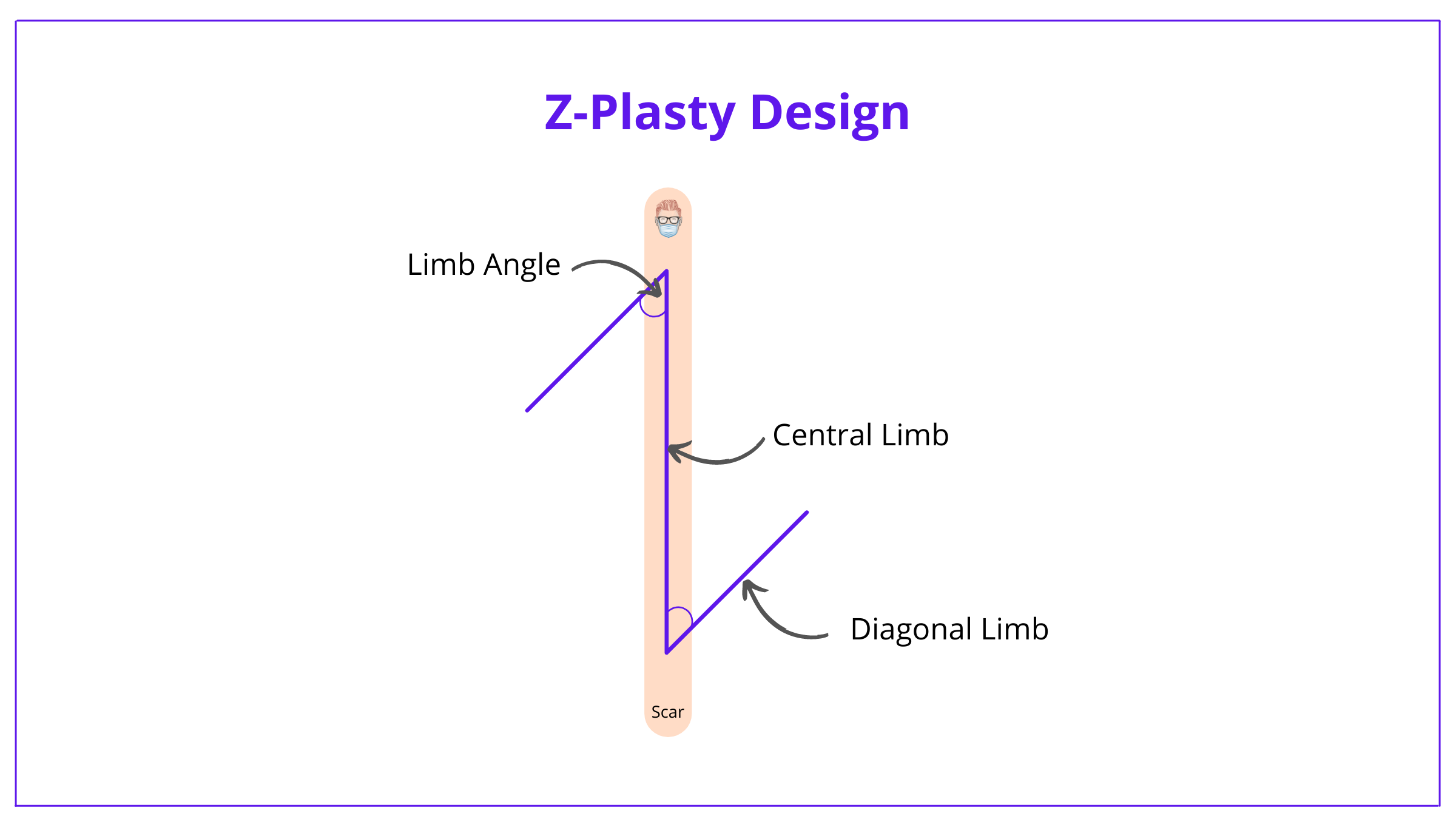 Z-plasty, Z-plasty flap, z-plasty design, z-plasty technique, z-plasty complications