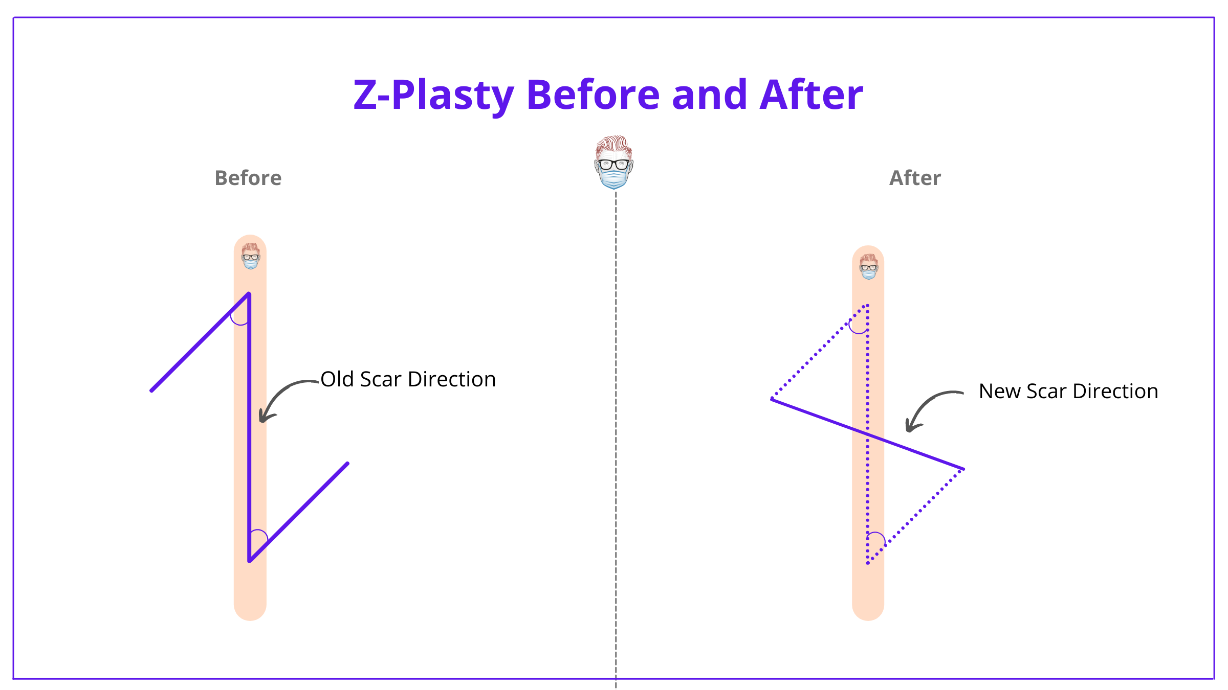 Z-plasty, Z-plasty flap, z-plasty design, z-plasty technique, z-plasty complications