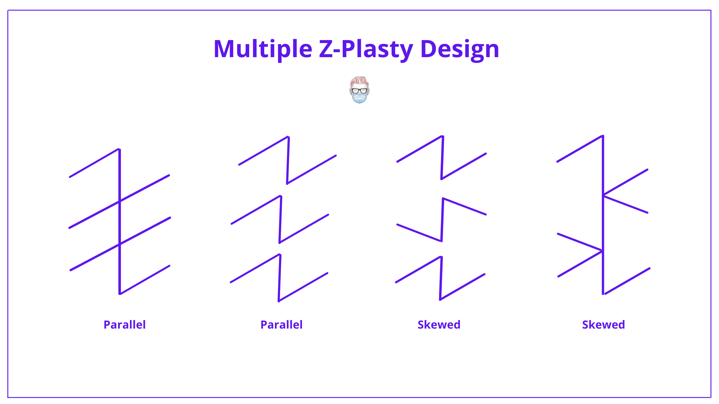 Z-plasty, Z-plasty flap, z-plasty design, z-plasty technique, z-plasty complications